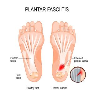 Plantar fasciitis in the foot.