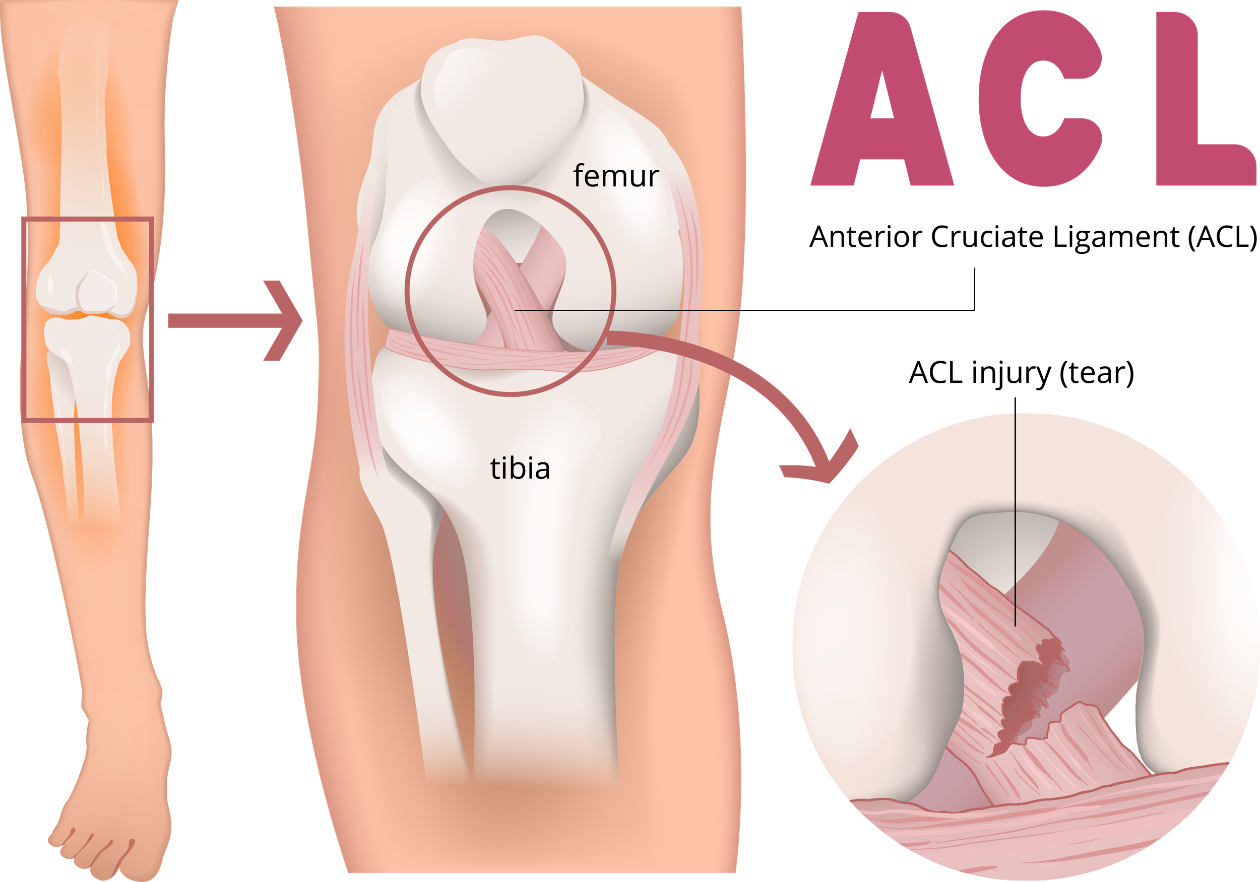 A knee with acl and a knee with acl.